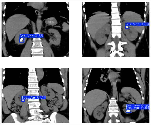 Kidney Stone Detection YOLOv8